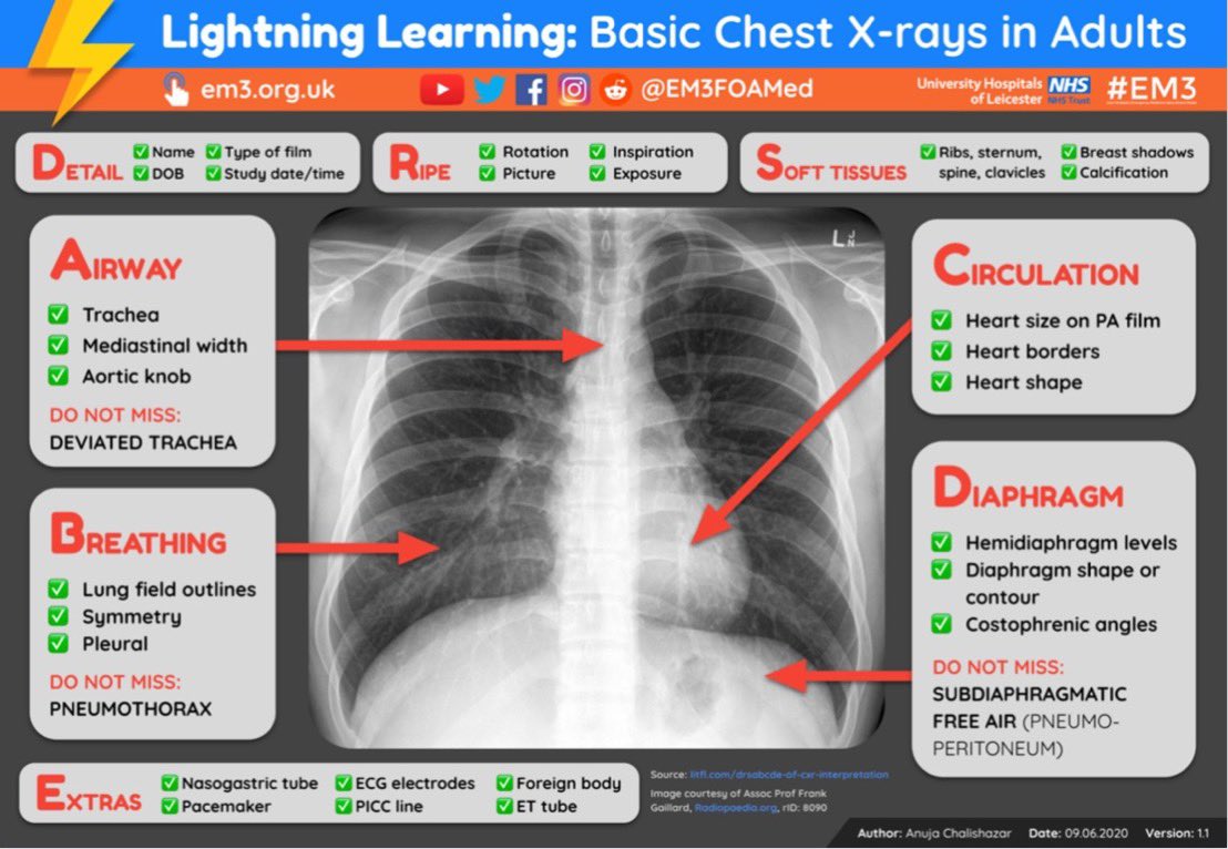 Basic Chest X-ray interpretation @EM3FOAMed #Xray