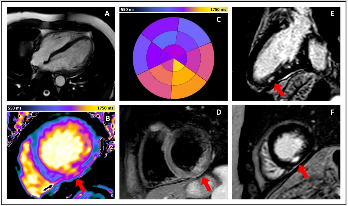 CircImaging (@circimaging) on Twitter photo MINOCA? Aortitis? Adrenal hematoma? Can you link all of them? This case report shows Antiphospholipid Syndrome as a "Clinical Chimera" and remarks the importance of multimodality imaging <a href="/pizzi_carmine/">Carmine Pizzi</a> <a href="/Daniele_Cav/">Daniele Cavallo</a> <a href="/matt_armi/">Matteo Armillotta</a> <a href="/Otavio_Coelho_F/">OTAVIO RIZZI COELHO FILHO, MD PhD MPH</a> ahajournals.org/doi/abs/10.116… MINOCA? Aortitis? Adrenal hematoma? Can you link all of them? This case report shows Antiphospholipid Syndrome as a "Clinical Chimera" and remarks the importance of multimodality imaging <a href="/pizzi_carmine/">Carmine Pizzi</a> <a href="/Daniele_Cav/">Daniele Cavallo</a> <a href="/matt_armi/">Matteo Armillotta</a> <a href="/Otavio_Coelho_F/">OTAVIO RIZZI COELHO FILHO, MD PhD MPH</a> ahajournals.org/doi/abs/10.116…