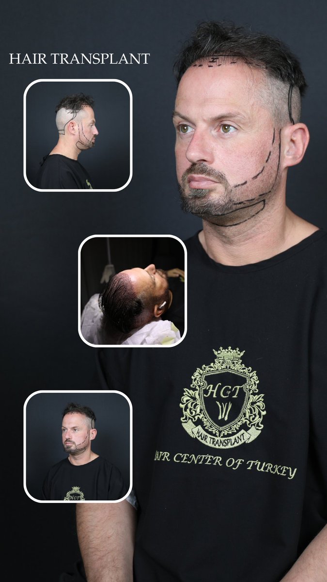 You can contact our clinic for more detailed information about hair transplantation.

#hairtransplant
#hairline
#hair
#hairtransplantistanbul
#hairtransplantinturkey

haircenterofturkey.com