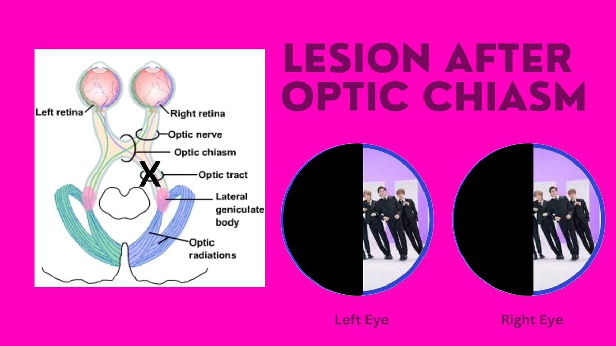 If the lesion occurs after the optic chiasm, then fibers from both CNIIs are damaged, and one visual field in both eyes (on the opposite side of the lesion) is lost (hemianopia). The opposite field is preserved because of those crossing fibers!