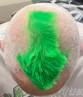 Indiana Center for Musculoskeletal Health (@iuicmh) on Twitter photo For the 13th year in a row, ICMH member Dr. Ed Greenfield participated in the <a href="/StBaldricks/">St. Baldrick's Foundation</a> Foundation head-shaving fundraiser to conquer childhood cancer. To learn more about this excellent foundation and to get involved, check out stbaldricks.org For the 13th year in a row, ICMH member Dr. Ed Greenfield participated in the <a href="/StBaldricks/">St. Baldrick's Foundation</a> Foundation head-shaving fundraiser to conquer childhood cancer. To learn more about this excellent foundation and to get involved, check out stbaldricks.org