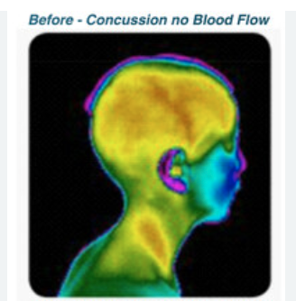 NeuroHealthPerf's tweet image. CSRT(Cranial Suture Release Therapy) utilizes micro-current stimulation to regulate the autonomic nervous system and manage concussion symptoms. It improves blood flow, cognitive functioning, and reduces pain. #CSRT #ConcussionSymptoms
