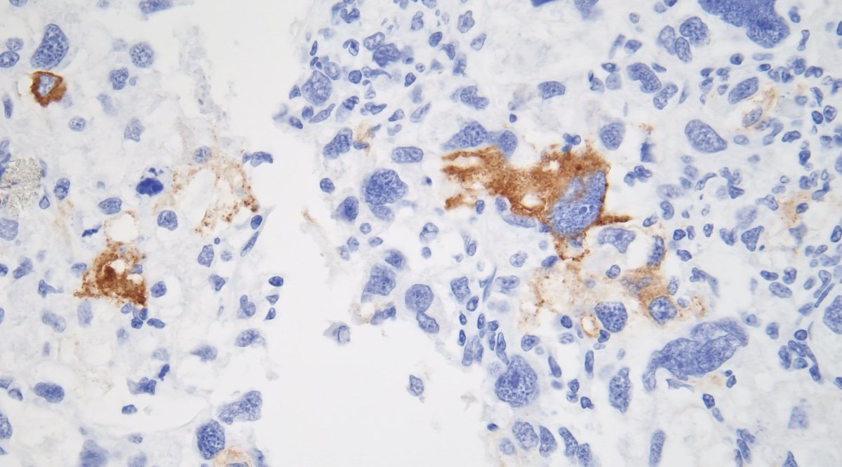 Abdominal mass with HMB45:

#PathTwitter #surgpath #BSTpath