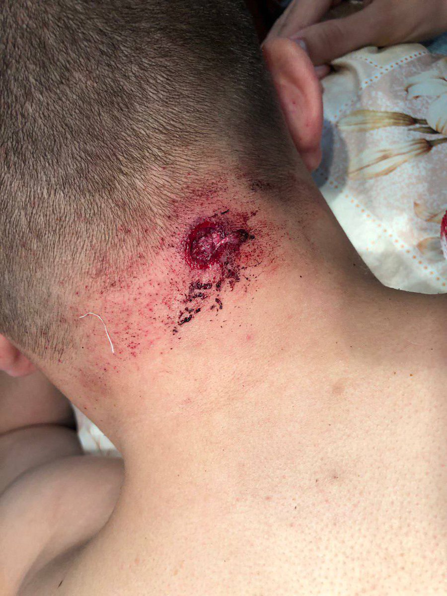 sternenko's tweet photo. 10 років позбавлення волі отримав виконавець другого нападу на мене. 

Щойно Приморський районний суд м. Одеси оголосив вирок Баймукашеву Абзалу Амангалійовичу у справі про ��амах на мене, який був 01.05.18

Того дня на замовлення Труханова він вистрілив мені у потилицю. Але оскільки я не втратив свідомість та став його переслідувати, мені вдалося його затримати. 

Баймукашева визнали винним у замаху на умисне вбивство та незаконному зберіганні та поводженні зі зброєю. 
Вирок набере законної сили за місяць з дня оголошення у разі, якщо не буде апеляційної скарги. 

Замовник Труханов, співучасники злочину, у тому числі поліціянти, підозр так і не отримали. 

Баймукашев це єдиний кого судили за напад на мене за усі три епізоди.

Процес по моєму самозахисту під час третього нападу триває та вже близький до вироку.