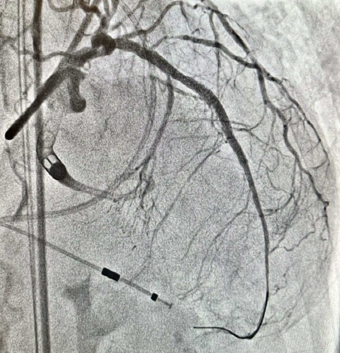 #CTOPCI #CaseFiles from #PennsyInterventions:  AWE with successful crossing but unable to traverse prox cap calcification with MC, requiring wiring with Rotawire via created micro-channel, and subsequent rotational atherectomy for optimized stent deployment. 
@ReVascMed