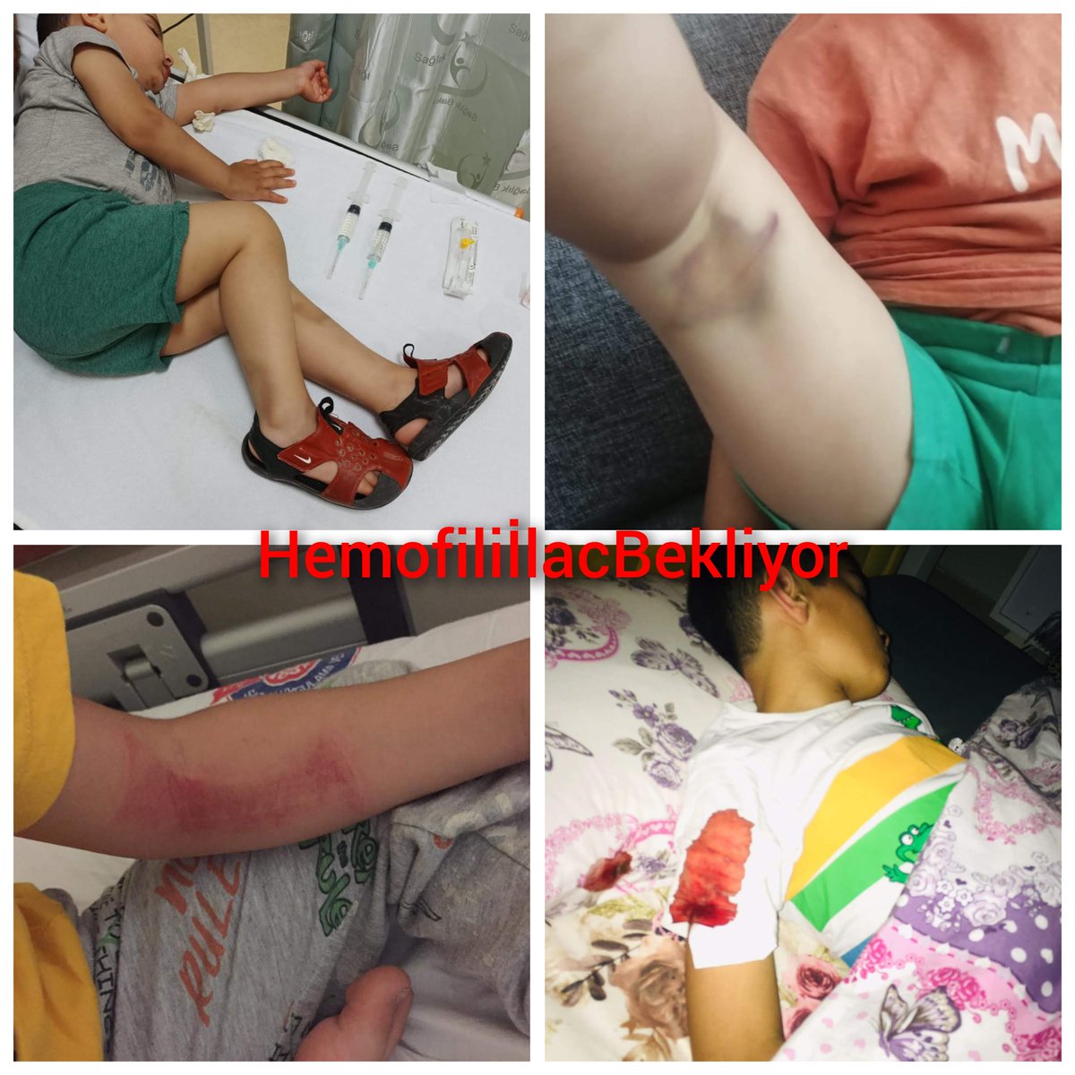 Bu çocuklar yıllardır kanıyor.. Tek yapılması gereken Sgk'nın hemlibra isimli derialtı ilacını ödeme kapsamına alması.. 

Bu kadar zor olmamalı, bu çocuklar bizim çocuklarımız.. 
#HemofiliİlaçBekliyor
