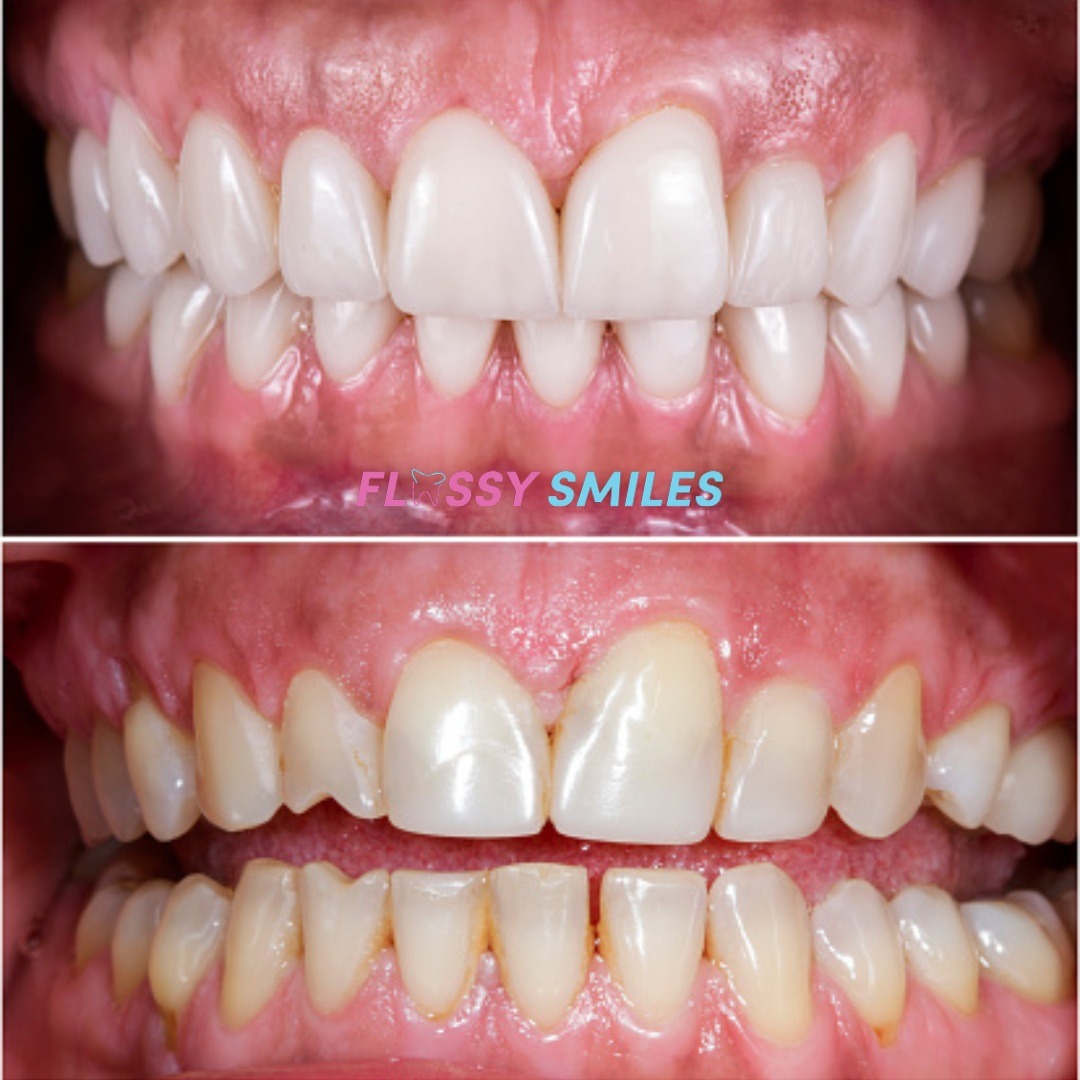 #Compositeveneers are an alternative to #porcelainveneers. Here is a before & after. Financially more affordable as well. Prices starting at $3489!
