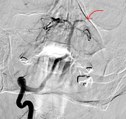 Twitter asks: "What is happening?!"

<a href="/CooperHealthNJ/">Cooper University Health Care</a>  answers: "We are treating acute stroke patients!"
 
✅TNK within 17 min of arrival
✅Thrombectomy for P2 occlusion (TICI 3)
⏭NIHSS improved from 17 to 5 at 24h

🤯

Shout out to <a href="/Oliveira_RAC/">Renato Oliveira</a> <a href="/hamzashaikhmd/">Hamza Shaikh, MD</a>!
