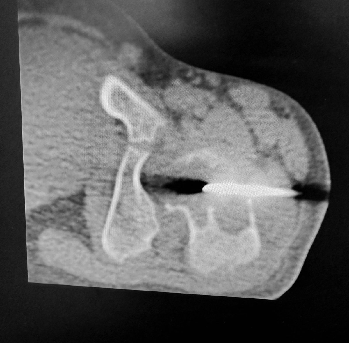Aneurysmal bone cyst steroid injection. #InterventionalRadiology #irad #radtwitter #MedTwitter #radres