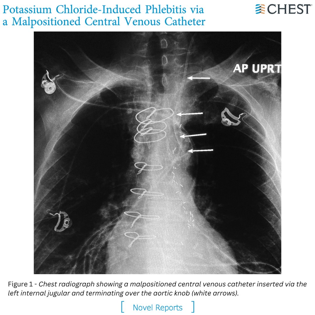 Potassium Chloride-Induced Phlebitis Via a Malpositioned Central Venous Catheter Read the full Novel Report in the June @journal_CHEST issue: hubs.la/Q01S-Fb30 #MedEd #MedTwitter