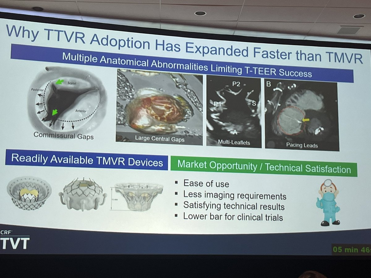 crfheart's tweet image. Are #TMVR devices designed to meet #tricuspid needs? Dr. Juan Granada examines the technological challenges and opportunities for #innovation in #TTVR. #TVT2023 #CardioEd #CardioResearch