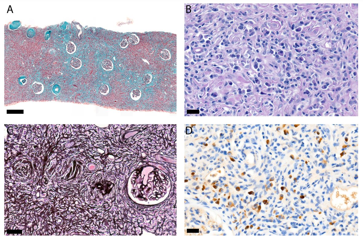 asnpublications's tweet image. IgG4-related kidney disease is a major manifestation of IgG4-related disease. This study found that IgG4-related kidney disease predominantly affected middle-aged males and manifested as tubulointerstitial nephritis with potential glomerular involvement bit.ly/CJASN0193