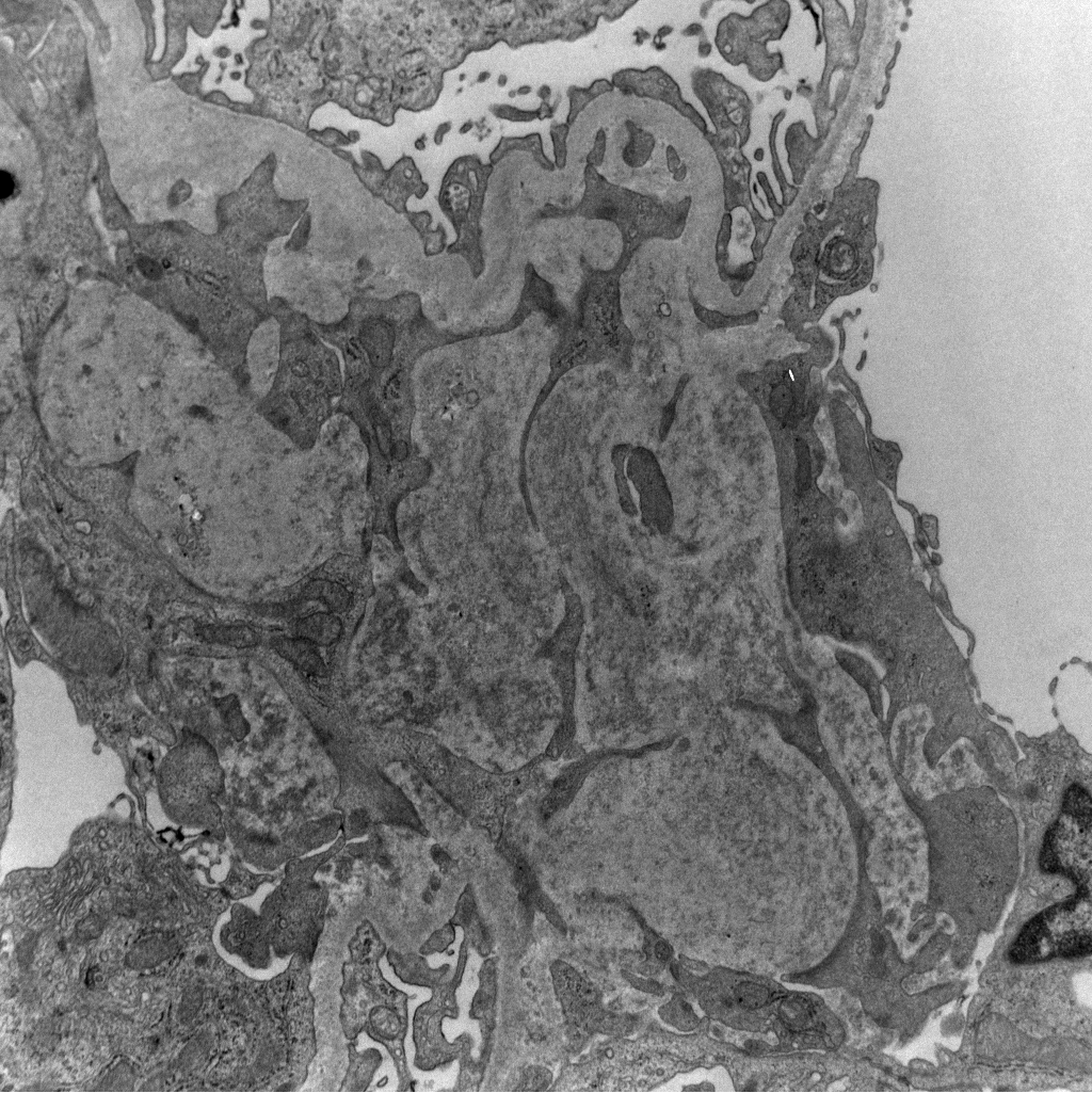 Unfortunately, great cases are almost always not good for the patient. This one has light chain cast nephropathy and deposition dz. PAS-weak casts with cellular reaction. Super bright kappa (lambda neg). Powdery electron-dense material along TBM and mostly mesangium #RenalPath