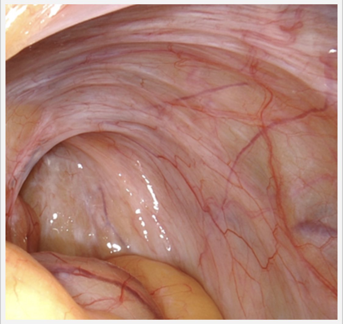Are you a gyn #surgeon?  Do you take care of #endometriosis?  Do you see endometriosis in this image?  Click on the link below and participate in our research study to find out if you’re right!  How good is your eye for #superficialendometriosis? redcap2.mayo.edu/redcap/surveys…