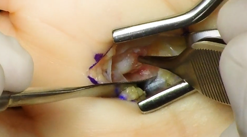 AAOS1's tweet photo. Now showing on OVT - watch this video demonstration of an open reduction of a locked #metacarpophalangeal joint: https://t.co/lTJR6SIVLv
#OpenReduction
@oamli2
#surgeon
#OVTFridays
#orthotwitter
#handsurgery
1600+ surgical videos available on Orthopaedic Video Theater! https://t.co/Fv6mIoPGbK