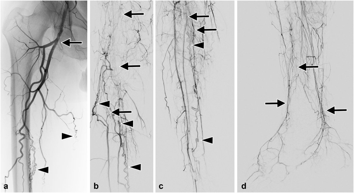 JVIRmedia's tweet photo. The Effect of Smoking Cessation on the Technical Success of Endovascular Treatment for Thromboangiitis Obliterans

https://t.co/yOj8Ctxy3P

Fig: Angiography of 41 y/o M with severe claudication (R3) diagnosed with thromboangiitis obliterans 10 years beforehand https://t.co/4CA1EAtmIW