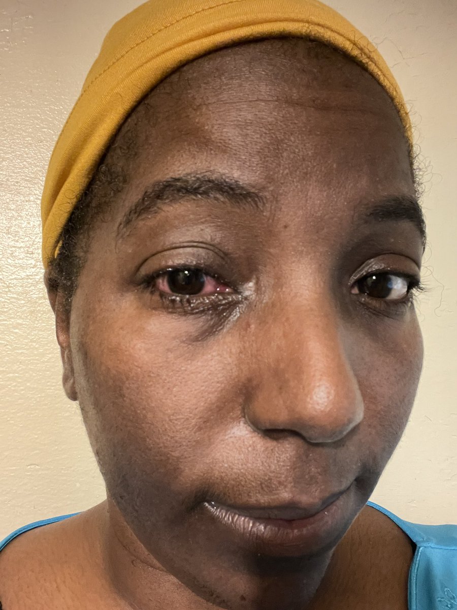 Empire_Eyes_'s tweet image. @Weaponization Look at my eye. It’s not fair to me I have to be sabotaged and abused from dews because an ex-friend is mad. He thinks he loves me. We don’t have the same beliefs and he’s too immature to see he actually hates me. Please hurry and close the program. #EndTargeting