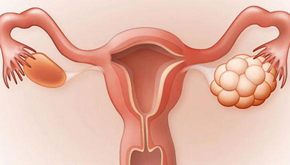 drapeggipinango's tweet photo. Existe relación entre el ambiente prenatal intrauterino y el riesgo de desarrollar #Sindromeovariopoliquistico en la edad adulta. El hiperandrogenismo, diabetes gestacional y sobrepeso de la madre durante el embarazo son factores de riesgo. Además influye la genetica y obesidad. https://t.co/IcaAm0Ibxg