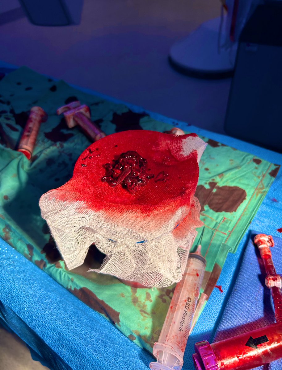 Jules Catt (@drjulescatt) on Twitter photo Meet the first team in ANZ to use the latest #mechanicalthrombectomy device to remove massive #PE. Privileged to be part of a team pursuing innovative healthcare which is based on tried and tested IR principles.
#flowtriever <a href="/InariMedical/">Inari Medical</a> <a href="/Glen_Schlaphoff/">Glen Schlaphoff</a> <a href="/Hannah_Ireland/">Hannah Ireland</a> Meet the first team in ANZ to use the latest #mechanicalthrombectomy device to remove massive #PE. Privileged to be part of a team pursuing innovative healthcare which is based on tried and tested IR principles.
#flowtriever <a href="/InariMedical/">Inari Medical</a> <a href="/Glen_Schlaphoff/">Glen Schlaphoff</a> <a href="/Hannah_Ireland/">Hannah Ireland</a>