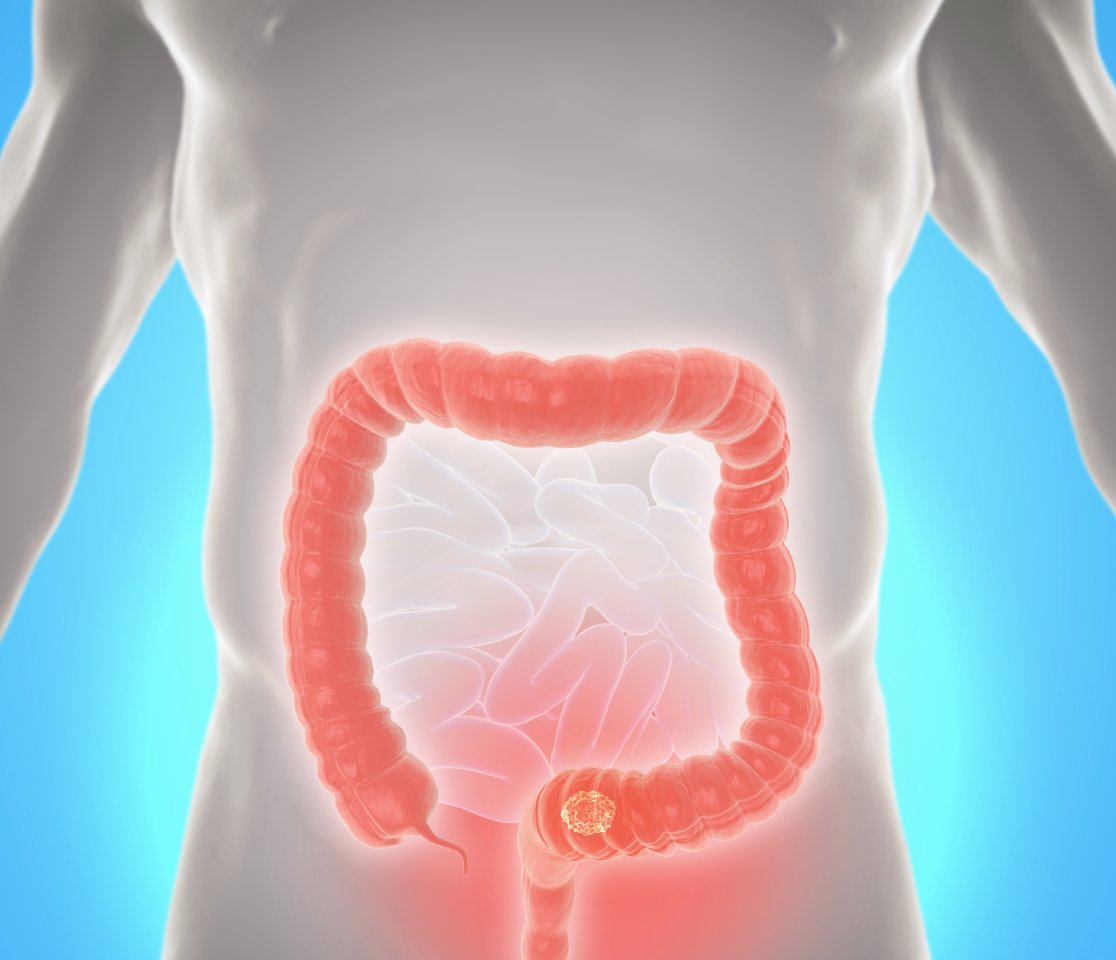 New study by Harvard medical school suggests a potential link between certain #gut bacteria and the development of #precancerous colon polyps. This finding could pave the way for interventions to prevent colorectal cancer. 

#CancerResearch #GutMicrobiome #Germany #medtwitter