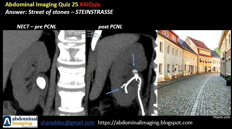 Abdominal Imaging Quiz 25
Steinstrasse: the street of stones. The stone fragments 'falë in line' àlong the Stent.

#FOAMed
#foamrad
#radtwitter #AIQuiz
For more such content visit:

abdominalimaging.blogspot.com