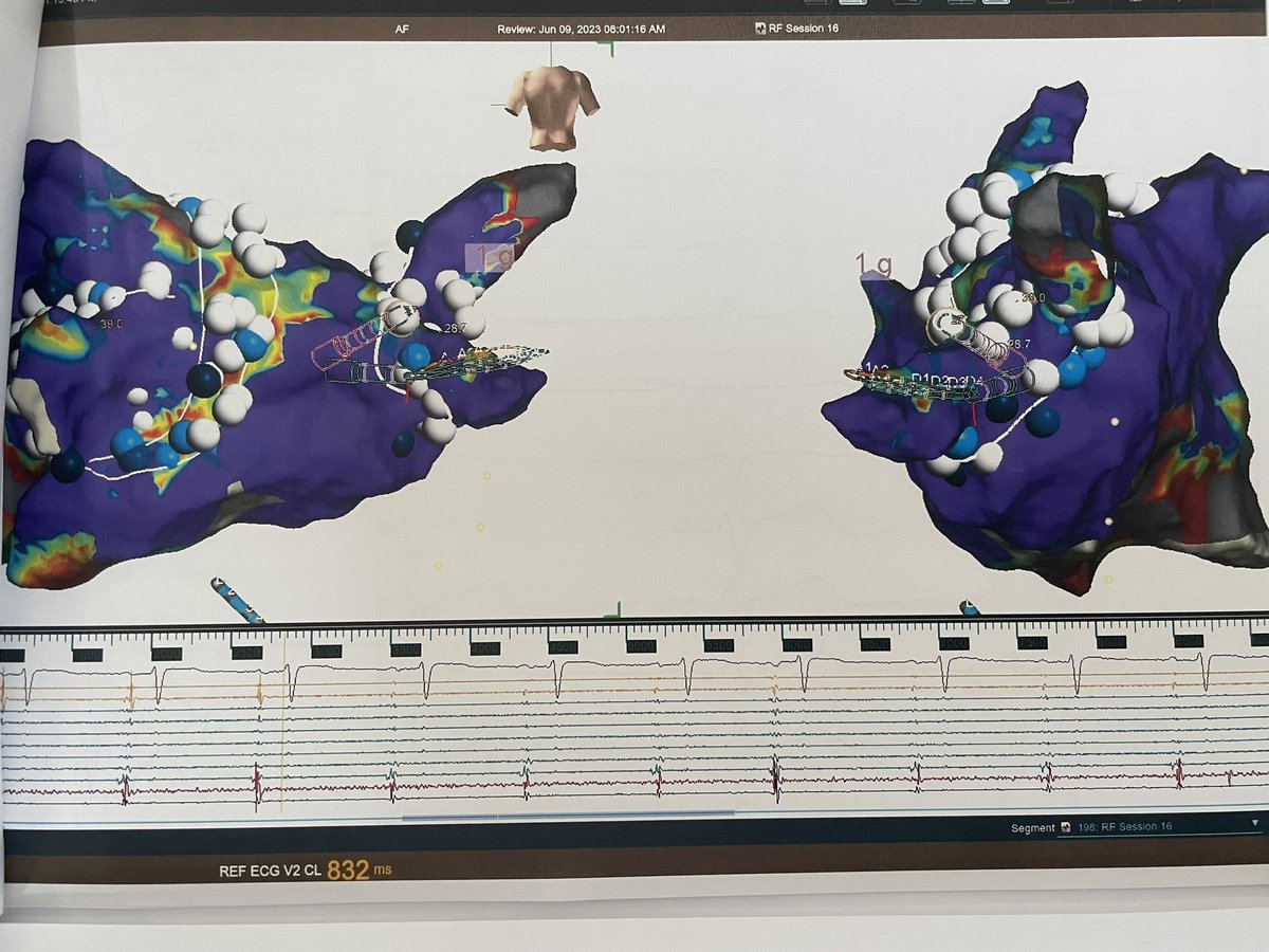 rfablation's tweet photo. #EPeeps #NoFluoro #OT guided #WACA with #ganglionatedpkexi #ablation in 55M with recurrent syncopal paroxysmal #atrialfibrlation. @messapus @MDTolgaAksu @DrRoderickTung https://t.co/aFKl6itpUl