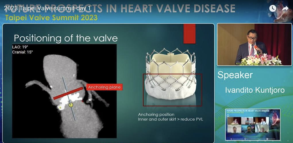 Ditongaje's tweet photo. TAVR optimization using BE for #Bicuspid AS. Using the newest generation of #tavi #tavr, virtual sizing and be able to recognise the potential problem have shown excellent result even in challenging anatomy. #taipeivalve2023 #nuhcs #apsic #cardiologist #structuralintervention https://t.co/2WvIjgUI7x