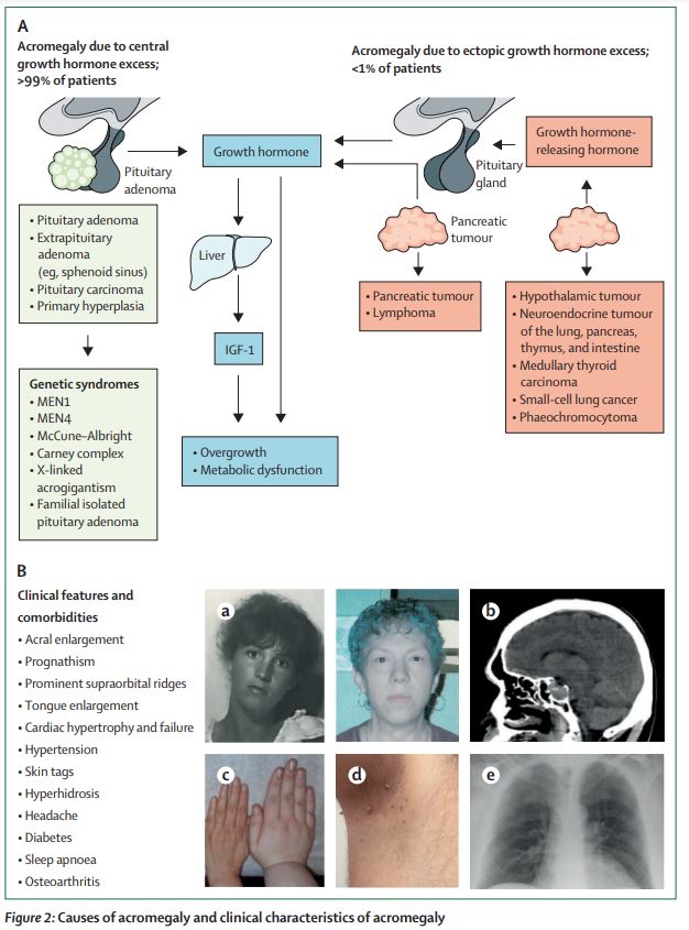 #Acromegaly: pathogenesis, diagnosis, and management thelancet.com/journals/landi… 
#pituitary #neuroendocrine 
#ENDO2023