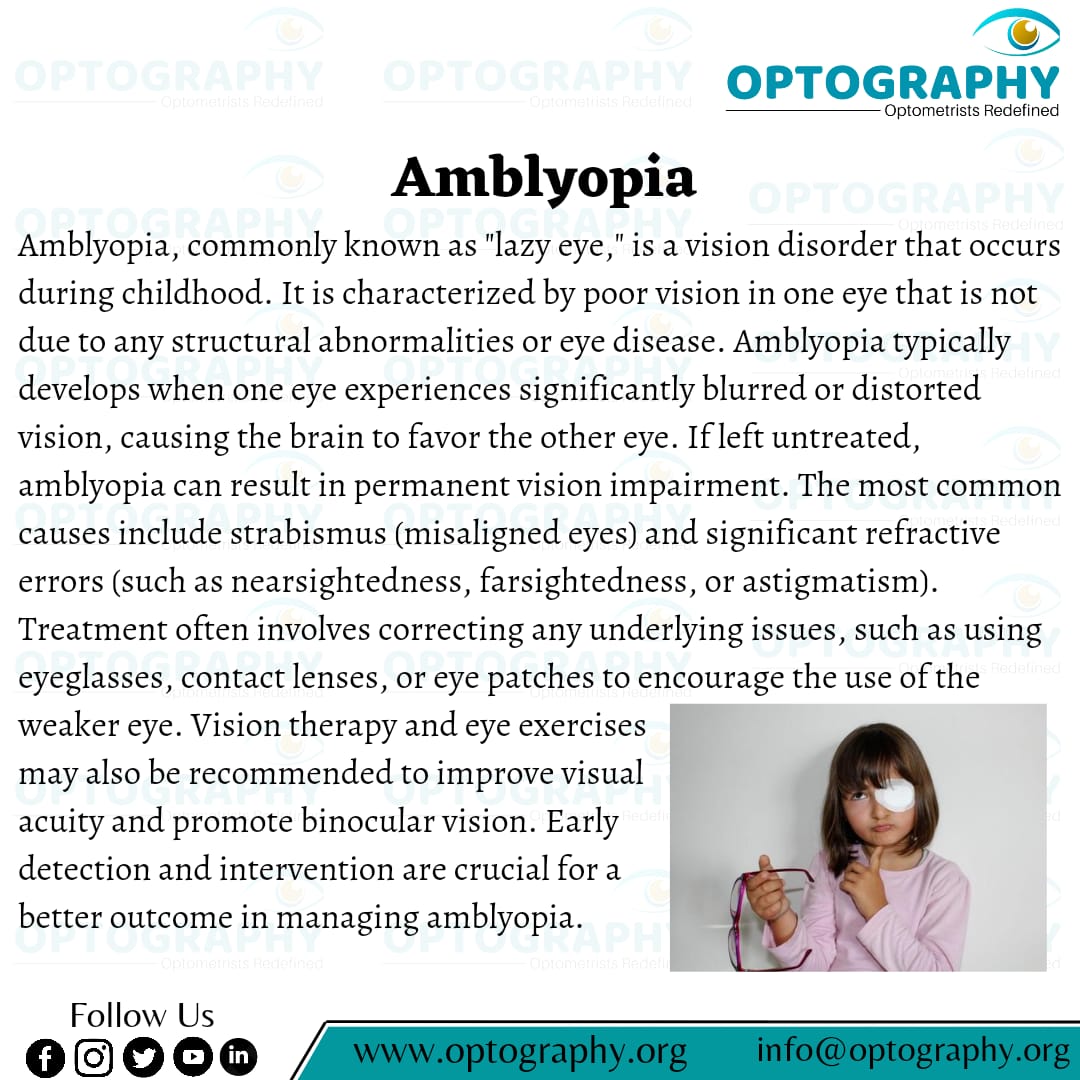 Amblyopia (also called lazy eye) is a type of poor vision that usually happens in just 1 eye but less commonly in both eyes. It develops when there's a breakdown in how the brain and the eye work together, and the brain can't recognize the sight from 1 eye.

#eyecare #optpgraphy