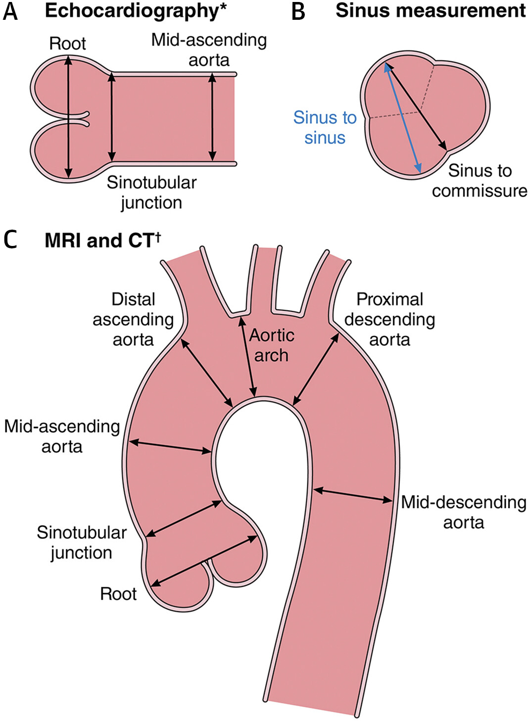 Aortic root measurement