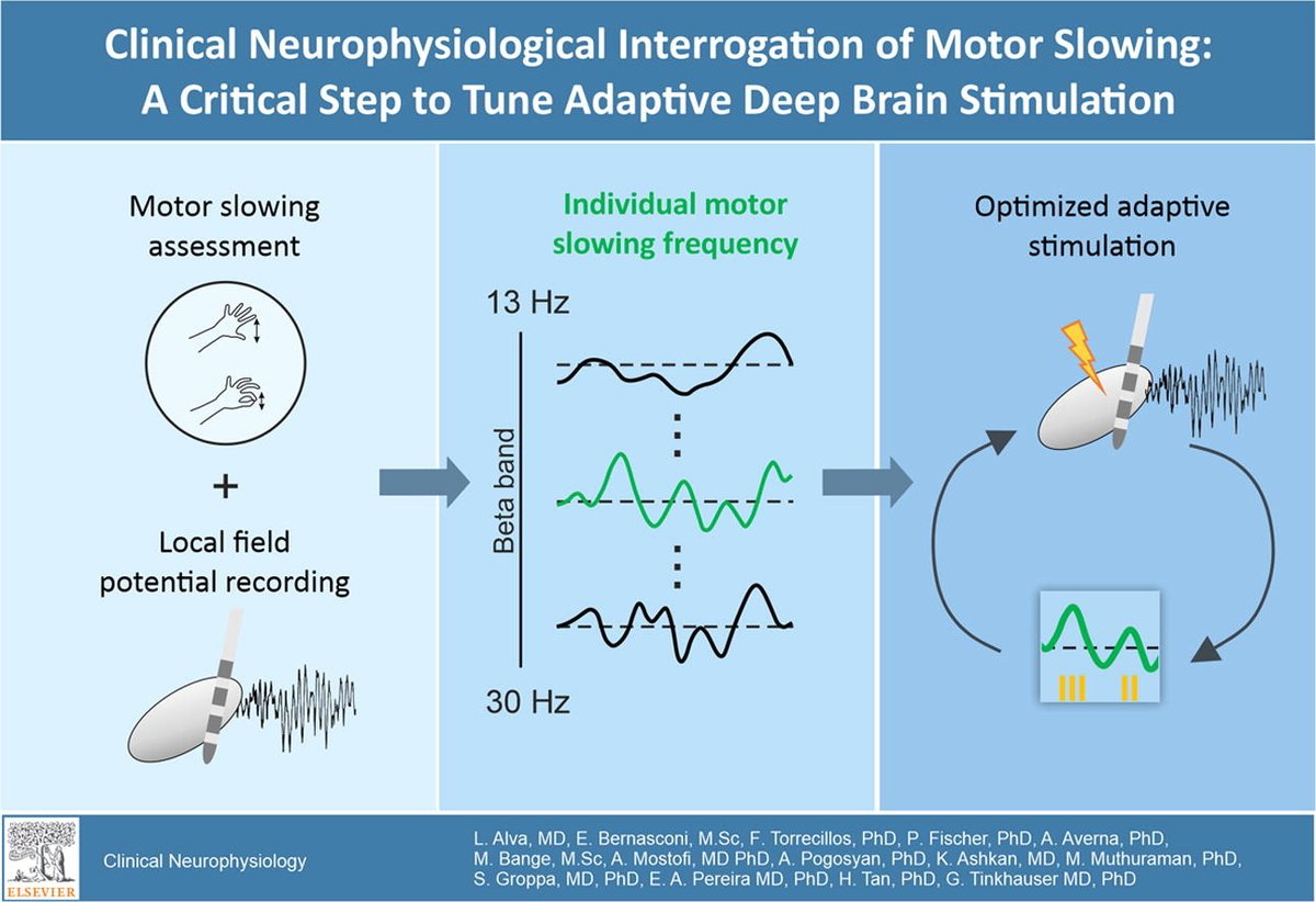Our new work is out: 'Clinical neurophysiological interrogation to Tune Adaptive DBS' Well done @AlvaLauraC and @ElenaBernasco! great collaboration with @segroppa @PetraFischer1 @AAverna7 @muthu100680 @eacp H. Tan, F. Torrecillos, M. Bange and others! sciencedirect.com/science/articl…