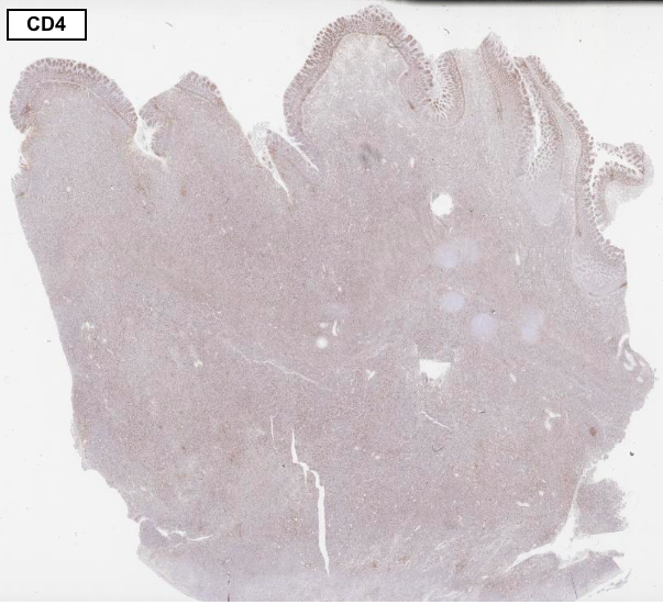 Monomorphic epitheliotropic intestinal T-cell lymphoma:
🩸Originates from resident intestinal γδ T-cells
🩸CD2+, CD3+, CD4−, CD5−, CD7+, CD8+, CD56+
🩸Monotonous medium-sized lymphocytes
🩸NOT associated with Celiac disease
#hemepath #lymsm #PathTwitter #GIpath #MedTwitter