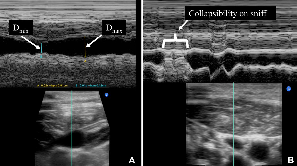 Presenting the POCUS-JVD study!
authors.elsevier.com/a/1hE1D2dHVQ8x…

#POCUS of jugular vein is an easy and reliable method for volume status estimation in daily practice.
A diameter variation < 30% --> RA pressure ≥10 mmHg and PAPi <3.

#CardioTwitter #MedTwitter #MedEd #emergencymedicine