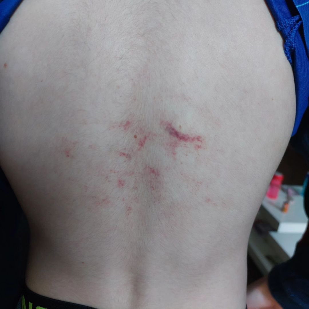 vrln_v's tweet photo. Mon petit frère autiste de 9ans est rentré de l’école il y a 1 semaine avec ça dans le dos. Cela fais maintenant plus d’1an qu’il est harcelé a l’école par les mêmes personnes (2 frères) mais rien ne bouge (école, gendarmerie, mairie etc…). Les réseaux sont notre dernière chance https://t.co/F2mqUrWmAm