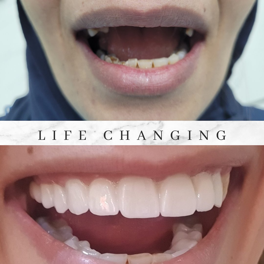 ClinicLdc's tweet photo. missing one tooth would decrease the effectiveness of the digestive system by 25% and it will only keep decreasing the more teeth we lack, Dental Implants are indeed nothing short of Life Changing.
#dentalclinic #smile #dentalcare https://t.co/UqKkUU9h2I