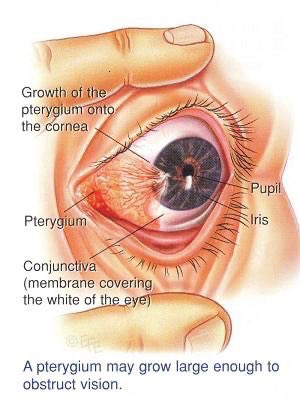 Pterygium #Ophthalmology #MedEd