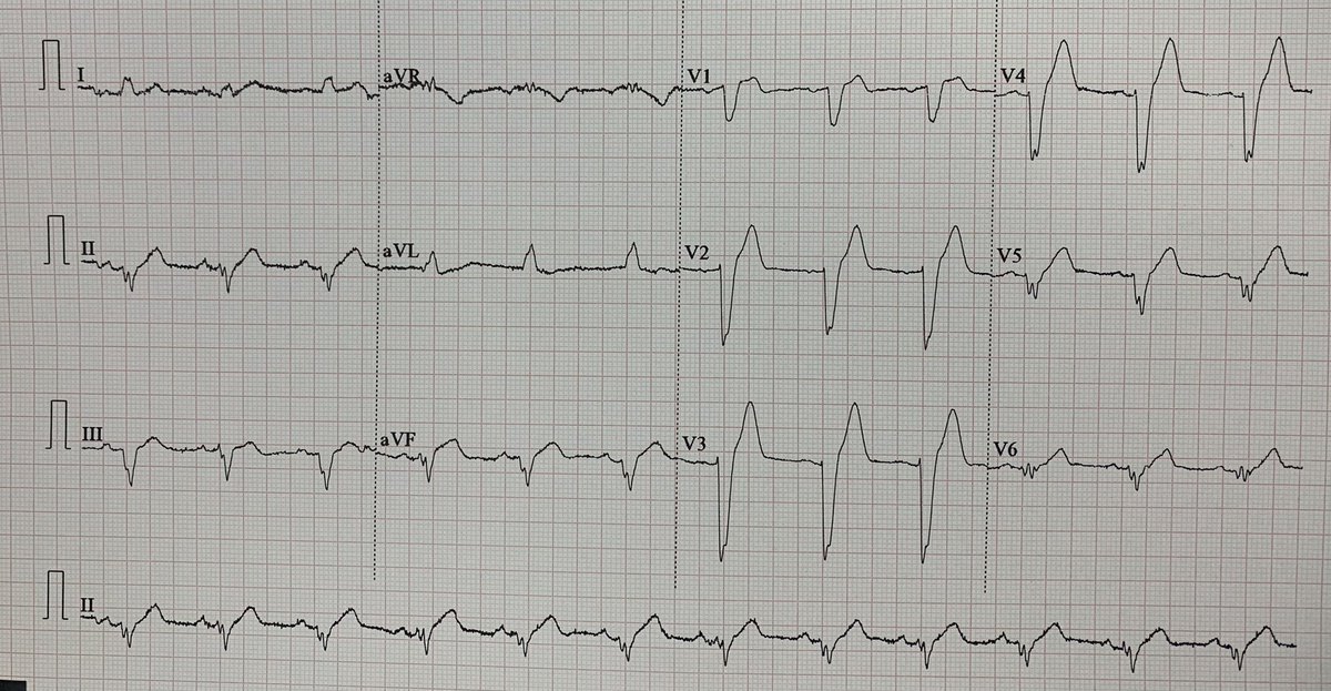 EcgsOnly's tweet photo. Chest pain 

OMI ? https://t.co/aky1JZ2mKz