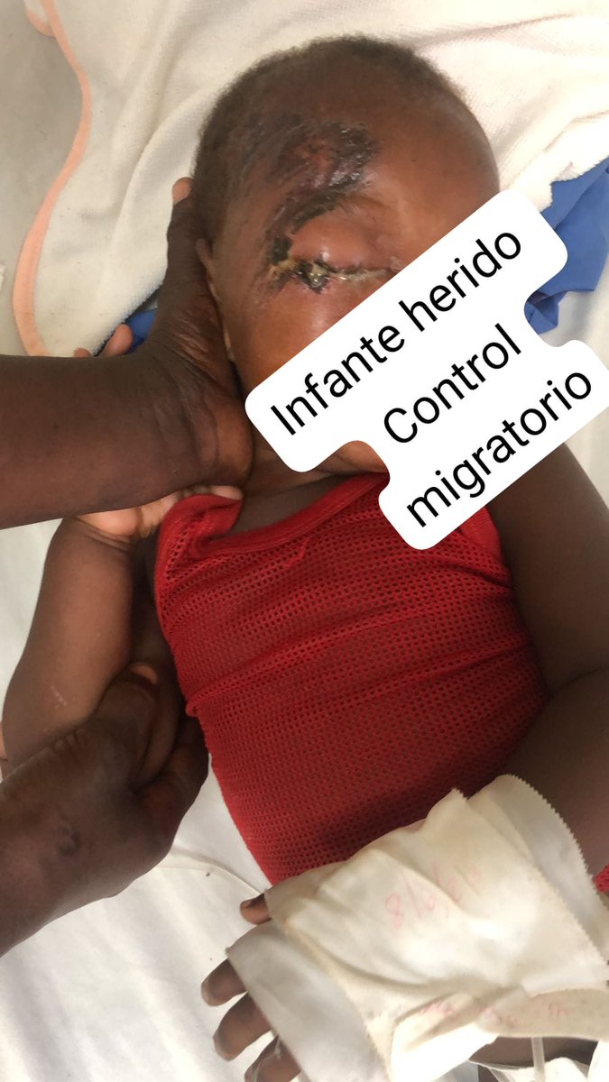 Fue trasladado ayer desde Mao al hospital infantil de Santiago bebe de 1 año herido en operativo migratorio en la entrada de la Yagua a la 1:00 AM el jueves 8 segun testimonios de familiares. Se pide a las autoridades investigar este nuevo caso que afecta la infancia.