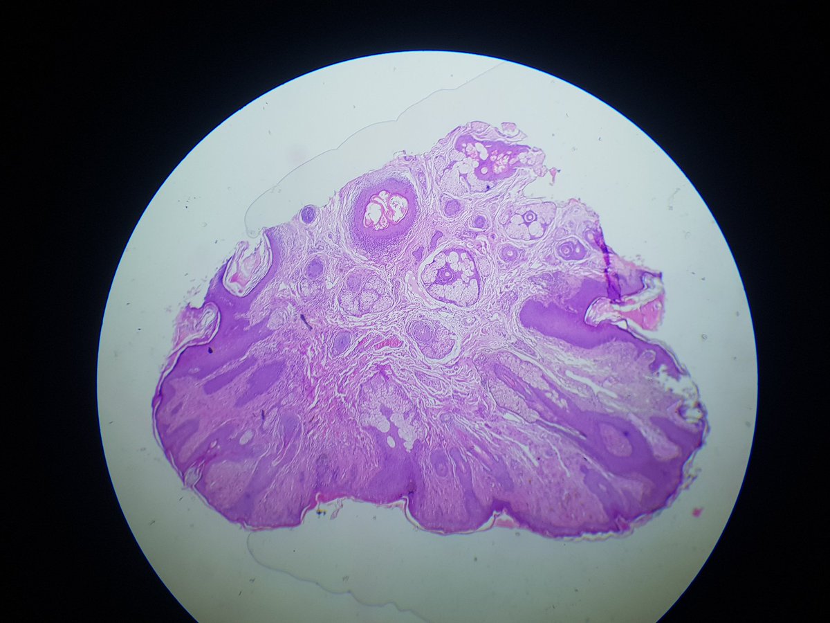 AlaaRowaid_88's tweet photo. 🔬13 Yrs old male with black to brwon warty lesion on nasolabial fold , since 6 yrs ago .
🔬 Is this pictures consistent with Trichofolliculoma?? Any comments !!?
#Dermatopathology 
#path 
#Skin https://t.co/os0ng9FITC