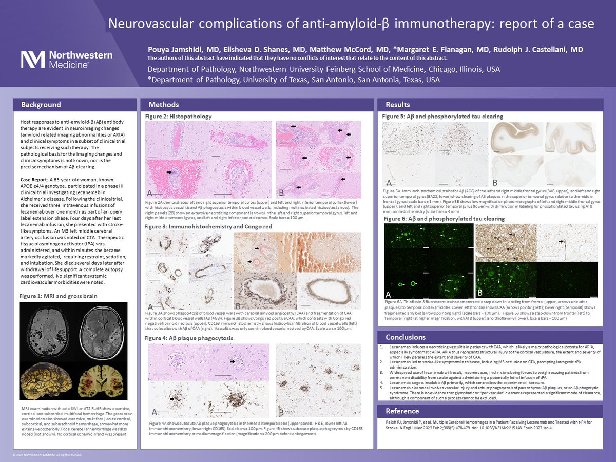 Check out our #AANP2023 poster on neurovascular complications of anti-amyloid-beta immunotherapy ⁦@neuropathology⁩ ⁦@ElishevaShanes⁩ ⁦@MccordMatt⁩ ⁦@MaggieFlanagan⁩ ⁦@RudyCastellani⁩ ⁦@NU_Pathology⁩ ⁦⁦⁩ ⁦@NUMesulamCenter⁩ ⁦