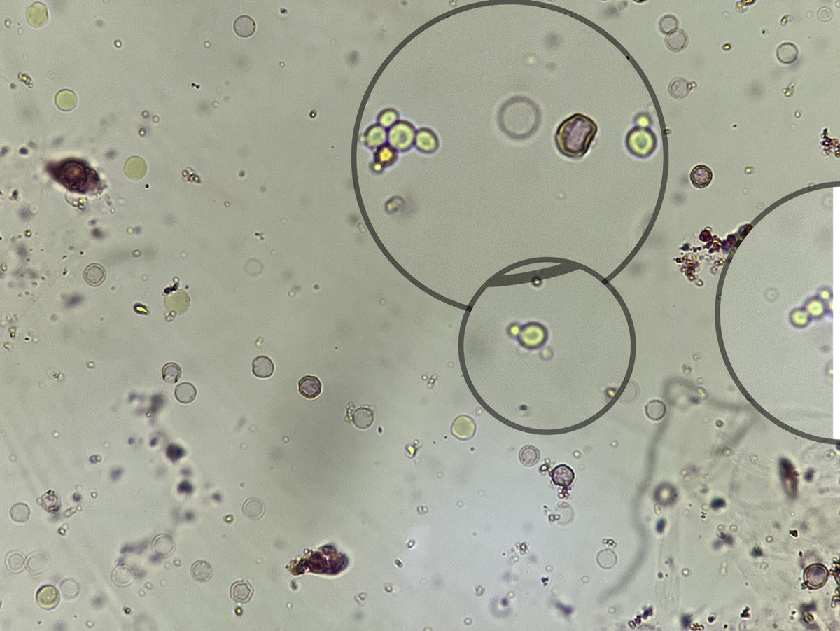 Urine microscopy finds at 2am in the morning 😅