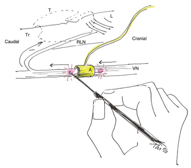 BjsOpen's tweet photo. 📜assessing safety of cont. intraop N. vagus neuromonitoring during thyroidectomy shows mild electrophysiological impact of electrode placement➡️however, diff negligible &amp; not assoc with clinical symptoms➡️safe to use during🔪#SoMe4Surgery @samira_sadowski
https://t.co/5B3JFxSguB https://t.co/oVpZYkS83A