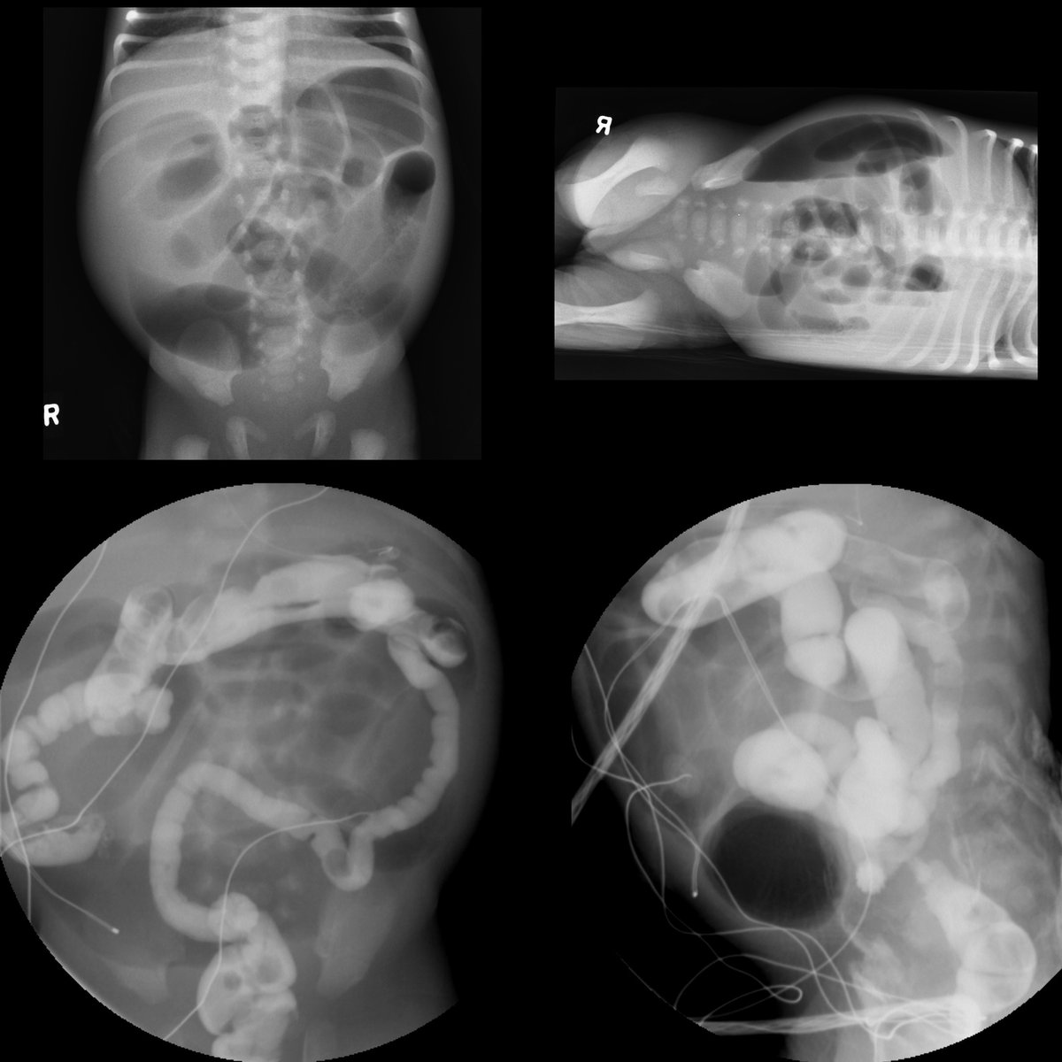 Newborn with failure to pass meconium

AXR supine (above left)+AXR left lateral decubitus (above right) show multiple dilated loops of bowel with no gas in rectum. 

#FOAMed #FOAMPed #FOAMRad #PedsRad #RadEd #RadRes #NICU #Neonatology #FOAMneo #PedSurgery #PedSurg #SoMe4PedSurg