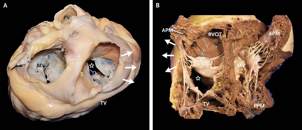 MAecocardio's tweet photo. Excelente revisión sobre la Insuficiencia Tricuspidea..imperdible en el NEJM 

https://t.co/5x53U5O8Ll https://t.co/5Fk0eVujFC