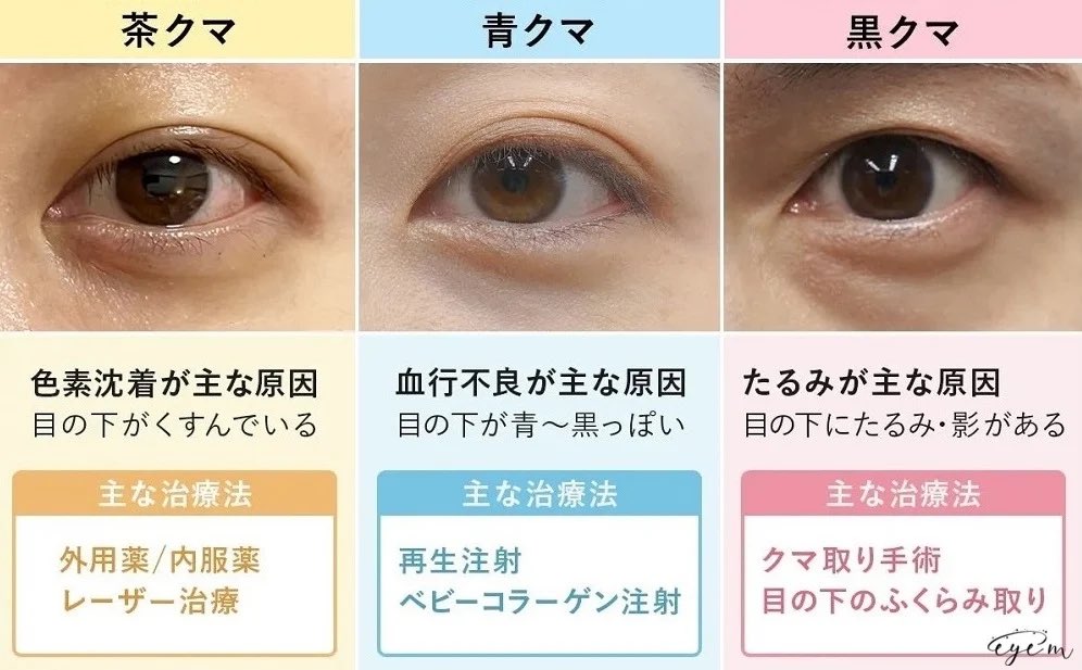 ptjgammj's tweet image. 目の下のたるみ取りは茶クマ、青クマ、黒クマで分ける。

一見、黒クマだと思っていても青クマが併発しているケースも多い。

その様な黒クマ＋青クマにヒアルロン酸注射は最悪の悪手。チンダル現象で青白くなる。

#目の下のクマ