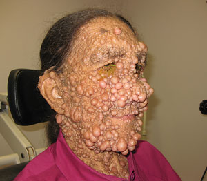 Why has no cure been found for the dermal manifestation of Von Recklinghausen disease (Neurofibromatosis I)?  I hate how vulgar that pathology can get. Let's not talk about the trauma of ostracization patients have to live with all their life! Mtscheeeeeeeeeeeeeeeeeeeeeeeeeeeew!