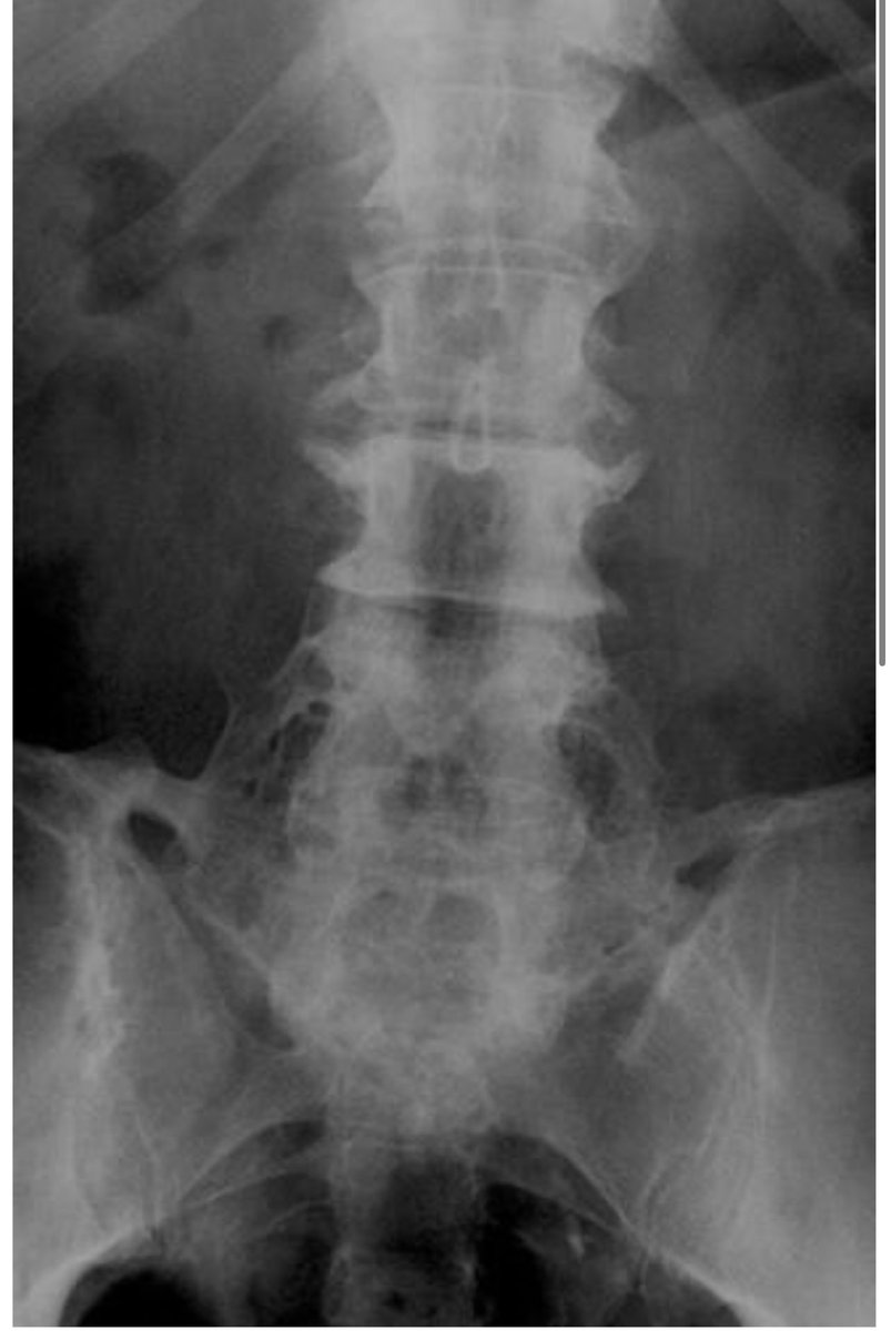 65/M
H/o chronic back pain 😥😩, 
What do you see? 
D/Ds! 
Rx! 
#rheumtwitter #orthopaedics #radiology #spine #medtwitter #arthritis