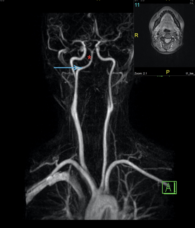 dnzmtlu's tweet photo. What structure is missing in this MRAngio? New report alert: An unusual cause of #syncope ! @TKDsosyal @bkultursay @pirilz @alikaragozmd #EPeeps #CardioTwitter #CardioEd 
https://t.co/b2A97jslxS https://t.co/mX8vI6hgTx