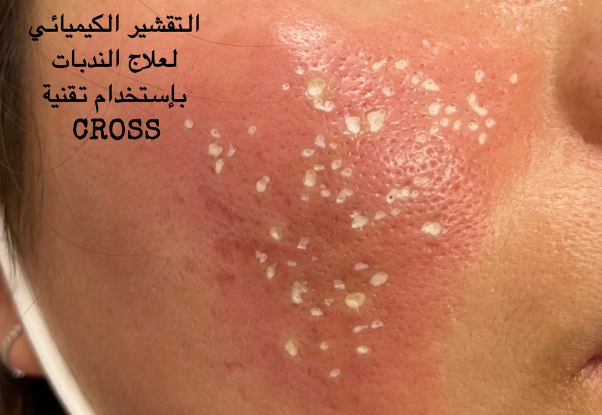 dr_3emadz's tweet photo. 🔹حقن الفيلر في الندبات. 

🔹التقشير الكيميائي.

🔹حقن محفزات النمو / محفزات الكولاجين.

🔹حقن الكوريتزون للندبات المرتفعه عن سطح الجلد.

🔹سنفرة الجلد dermabrasion https://t.co/00AReRvBzR