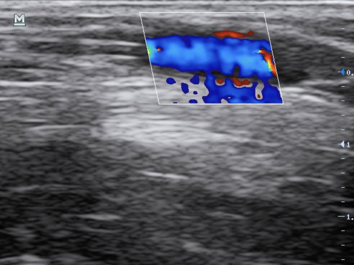 Excited to share our newest <a href="/CJEMonline/">CJEM</a> 'Just the Facts' paper on how to ace your next Ultrasound-Guided PIV

FREE/OPEN ACCESS LINK: rdcu.be/deeA7

<a href="/evieschraft/">Evie</a> <a href="/jimobrien_md/">James O'Brien</a> <a href="/dan___kim/">Dan Kim</a> 

#FOAMed #FOAMus #POCUS